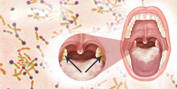 KHÔNG CHỦ QUAN VỚI BỆNH BẠCH HẦU